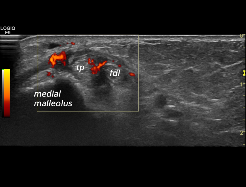 Tenosynovitis Tibialis Posterior And Flexor Digitorum Longus Tendon Sonotool® 4008